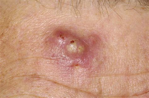 fotos de abscesos en la piel - classificações de alajuelense
